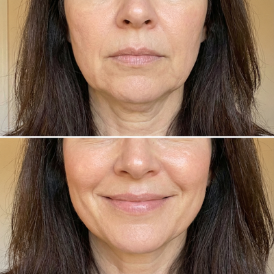 Antes y despues contorno